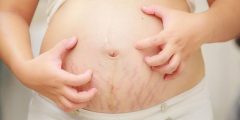 الصدفية أثناء الحمل: دليل للأعراض والعلاج والمخاطر على الأم والجنين