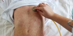 اعراض الحصبة عند الأطفال