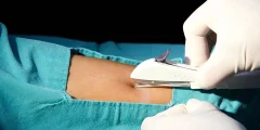كبسولة منع الحمل تحت الجلد: دليل طبي شامل عن الآلية